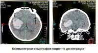 Нейрохирурги Тувы впервые малоинвазивной операцией растворили инсультную внутримозговую гематому