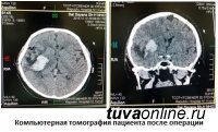 Нейрохирурги Тувы впервые малоинвазивной операцией растворили инсультную внутримозговую гематому