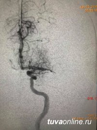 В Туве впервые провели высокотехнологичную операцию по удалению тромба из закупоренной крупной артерии головного мозга 